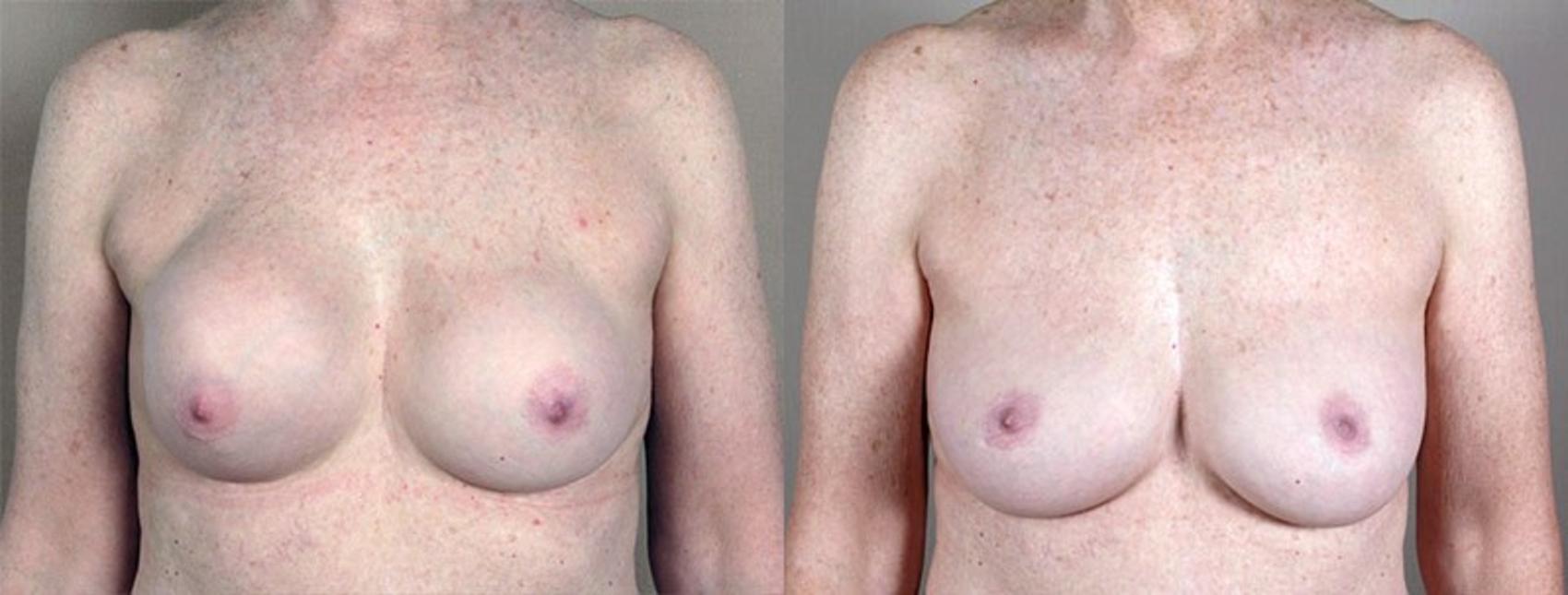 Breast Implant Revision Case 580 Before & After View #1 | Paramus, New Jersey | Parker Center for Plastic Surgery