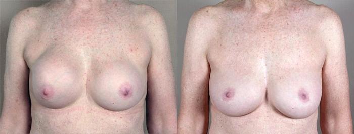 Breast Implant Revision Case 580 Before & After View #1 | Paramus, New Jersey | Parker Center for Plastic Surgery