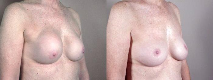Breast Implant Revision Case 580 Before & After View #2 | Paramus, New Jersey | Parker Center for Plastic Surgery