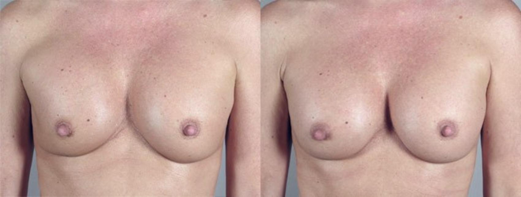 Breast Implant Revision Case 581 Before & After View #1 | Paramus, New Jersey | Parker Center for Plastic Surgery