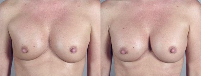 Breast Implant Revision Case 581 Before & After View #1 | Paramus, New Jersey | Parker Center for Plastic Surgery