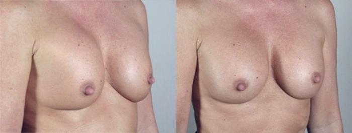 Breast Implant Revision Case 581 Before & After View #2 | Paramus, New Jersey | Parker Center for Plastic Surgery