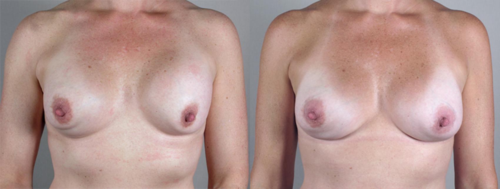 Breast Implant Revision Case 582 Before & After View #1 | Paramus, New Jersey | Parker Center for Plastic Surgery