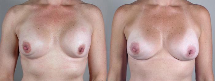 Breast Implant Revision Case 582 Before & After View #1 | Paramus, New Jersey | Parker Center for Plastic Surgery