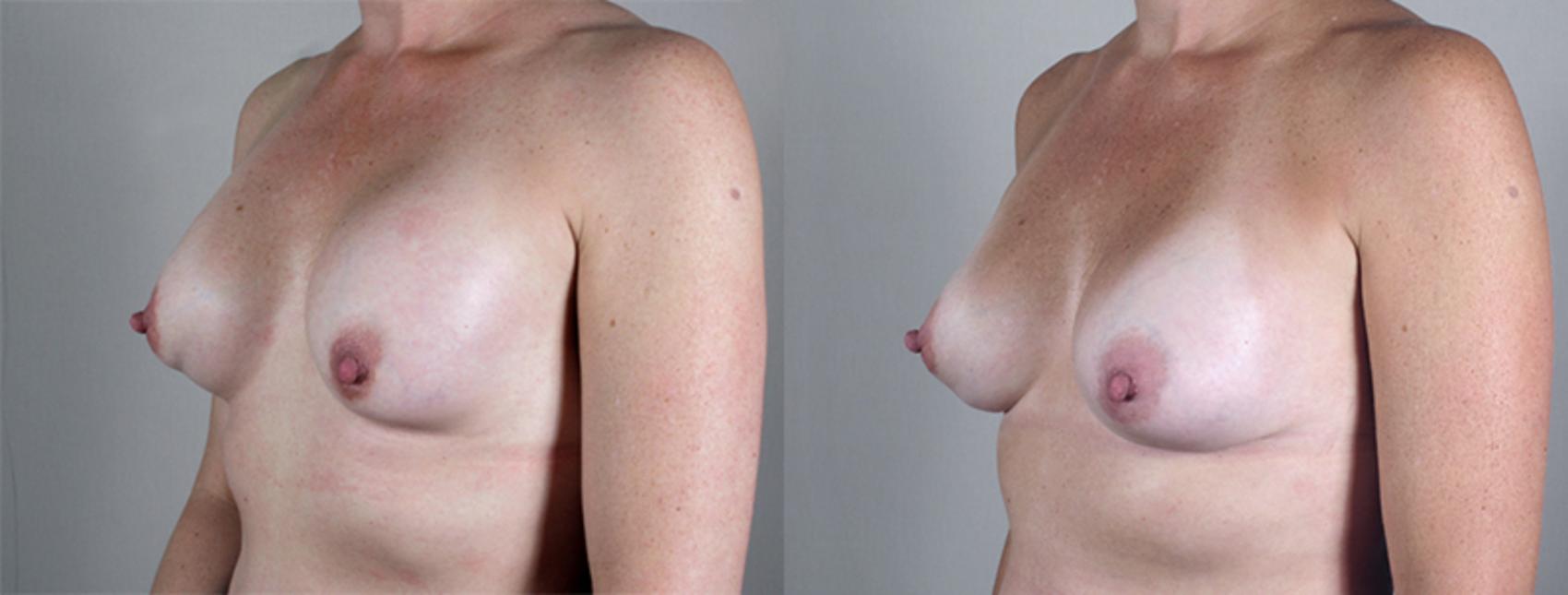 Breast Implant Revision Case 582 Before & After View #2 | Paramus, New Jersey | Parker Center for Plastic Surgery