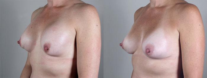 Breast Implant Revision Case 582 Before & After View #2 | Paramus, New Jersey | Parker Center for Plastic Surgery