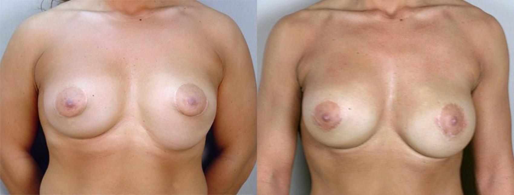 Breast Implant Revision Case 583 Before & After View #1 | Paramus, New Jersey | Parker Center for Plastic Surgery