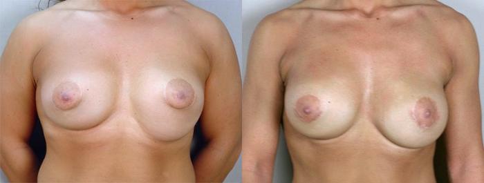 Breast Implant Revision Case 583 Before & After View #1 | Paramus, New Jersey | Parker Center for Plastic Surgery