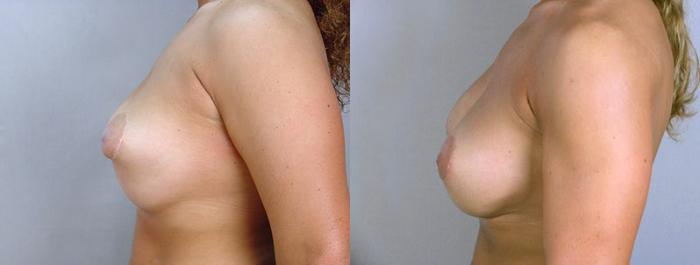 Breast Implant Revision Case 583 Before & After View #2 | Paramus, New Jersey | Parker Center for Plastic Surgery