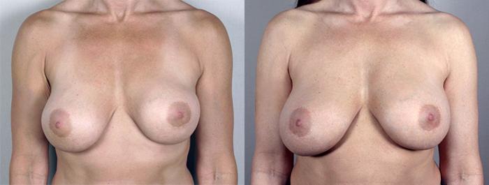 Breast Implant Revision Case 584 Before & After View #1 | Paramus, New Jersey | Parker Center for Plastic Surgery
