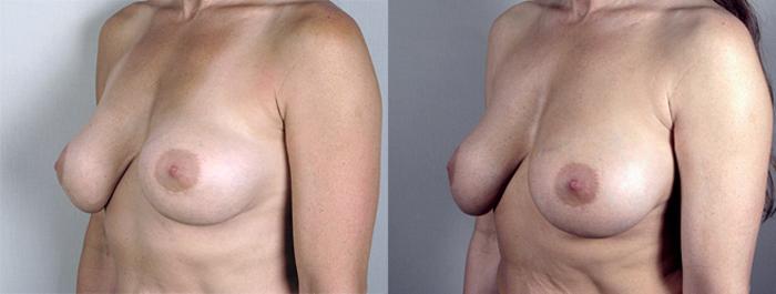 Breast Implant Revision Case 584 Before & After View #2 | Paramus, New Jersey | Parker Center for Plastic Surgery