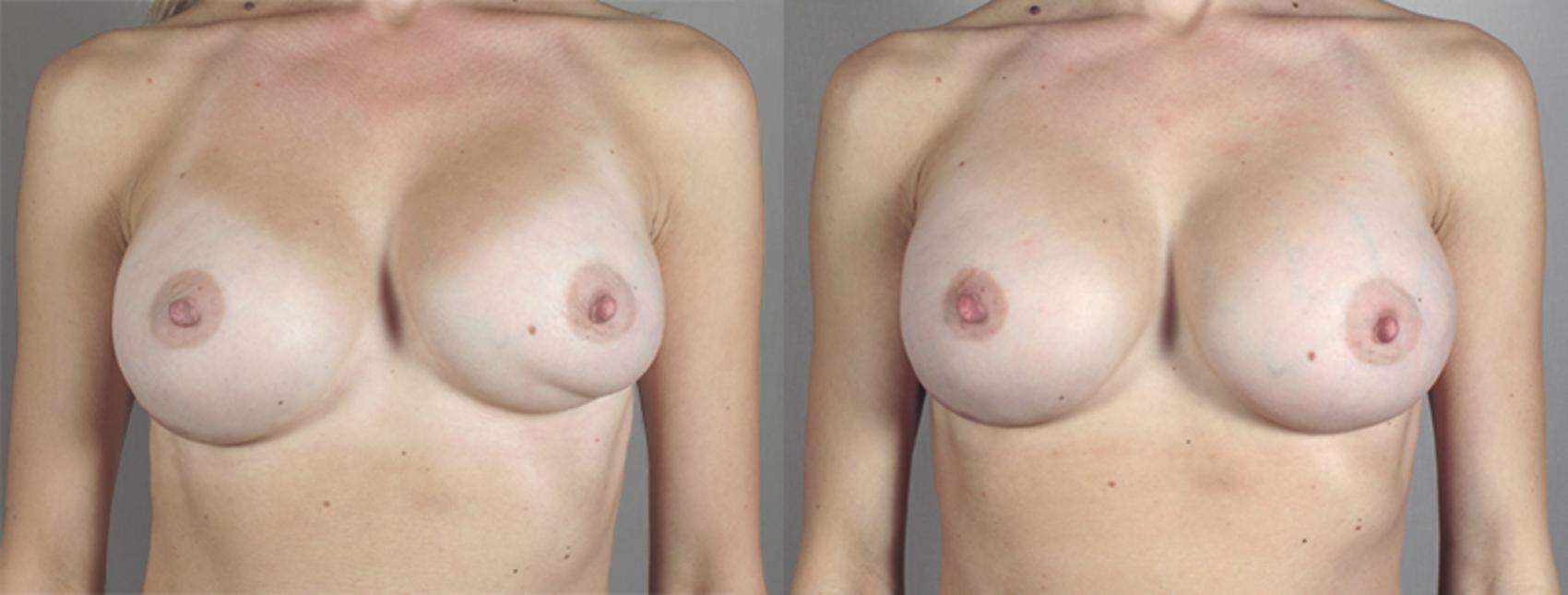 Breast Implant Revision Case 585 Before & After View #1 | Paramus, New Jersey | Parker Center for Plastic Surgery