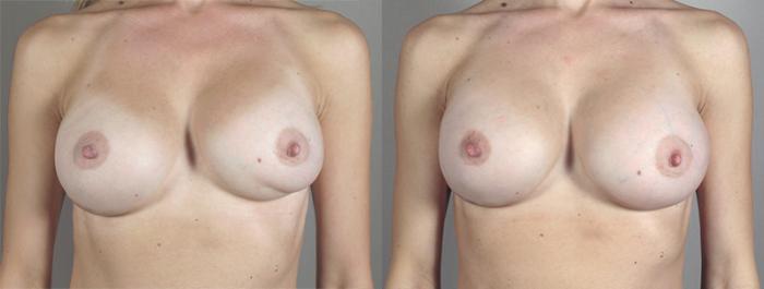 Breast Implant Revision Case 585 Before & After View #1 | Paramus, New Jersey | Parker Center for Plastic Surgery