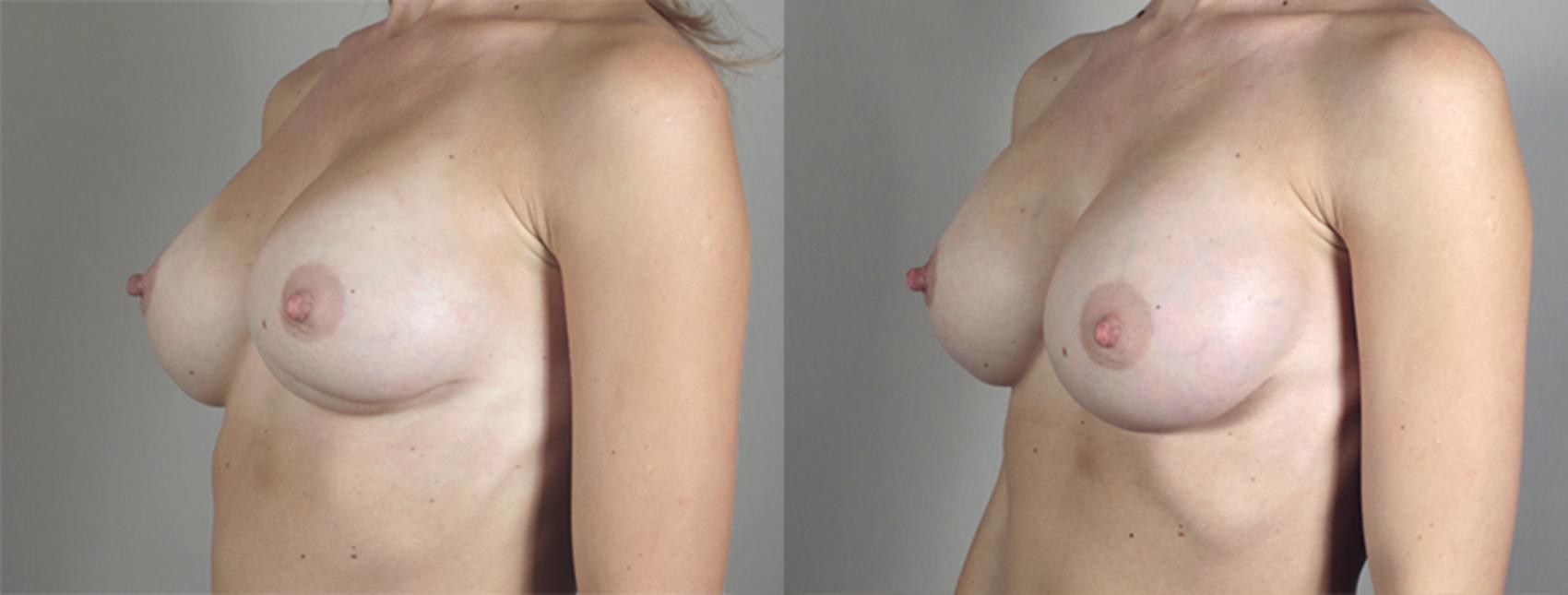 Breast Implant Revision Case 585 Before & After View #2 | Paramus, New Jersey | Parker Center for Plastic Surgery