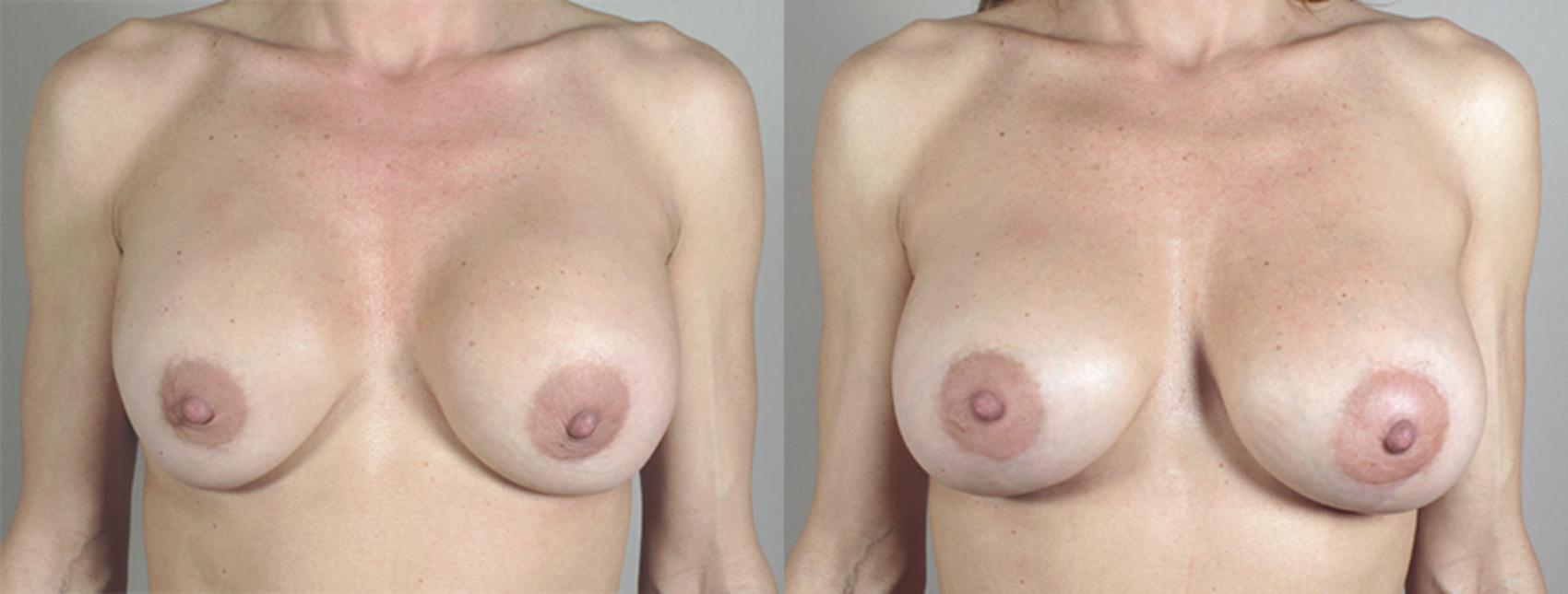 Breast Implant Revision Case 586 Before & After View #1 | Paramus, New Jersey | Parker Center for Plastic Surgery