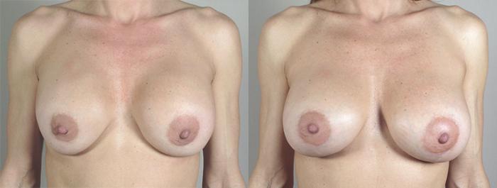 Breast Implant Revision Case 586 Before & After View #1 | Paramus, New Jersey | Parker Center for Plastic Surgery