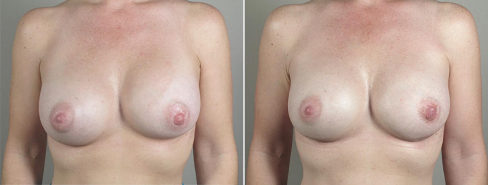 Breast Implant Revision Case 588 Before & After View #1 | Paramus, New Jersey | Parker Center for Plastic Surgery