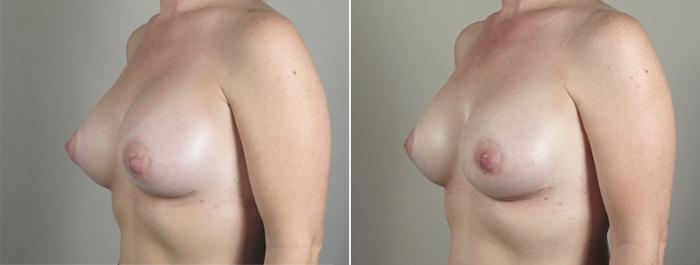 Breast Implant Revision Case 588 Before & After View #2 | Paramus, New Jersey | Parker Center for Plastic Surgery