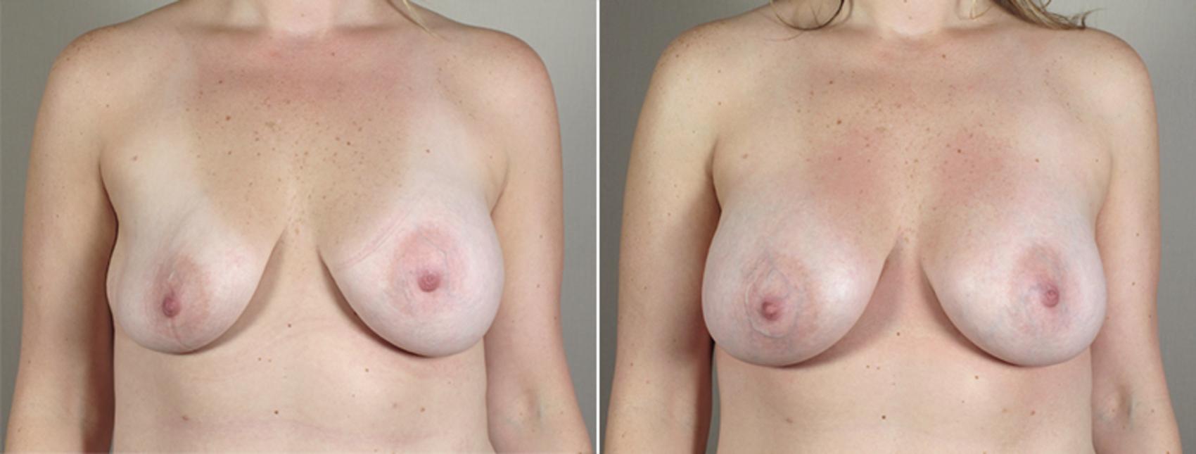 Breast Implant Revision Case 589 Before & After View #1 | Paramus, New Jersey | Parker Center for Plastic Surgery