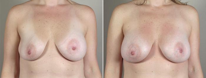 Breast Implant Revision Case 589 Before & After View #1 | Paramus, New Jersey | Parker Center for Plastic Surgery