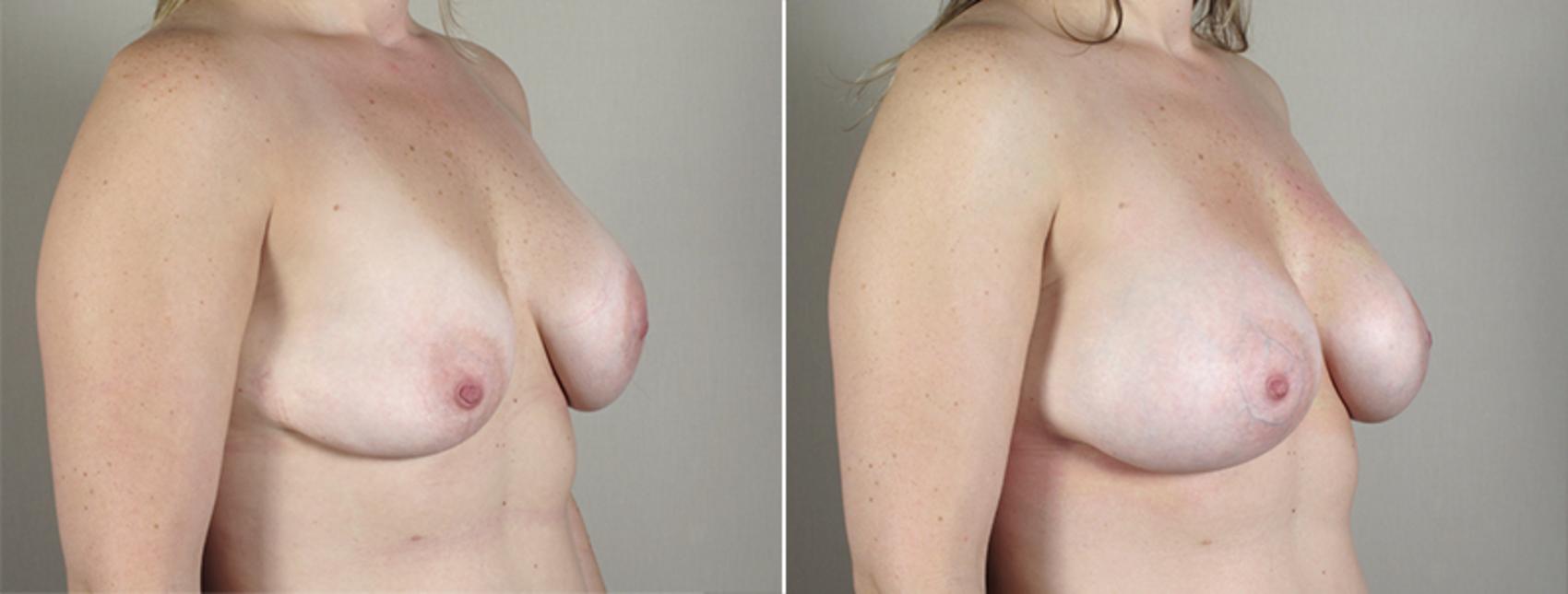Breast Implant Revision Case 589 Before & After View #2 | Paramus, New Jersey | Parker Center for Plastic Surgery