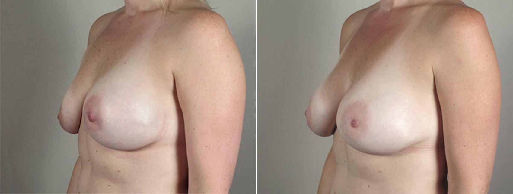 Breast Implant Revision Case 589 Before & After View #3 | Paramus, New Jersey | Parker Center for Plastic Surgery