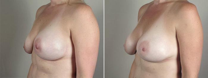 Breast Implant Revision Case 589 Before & After View #3 | Paramus, New Jersey | Parker Center for Plastic Surgery