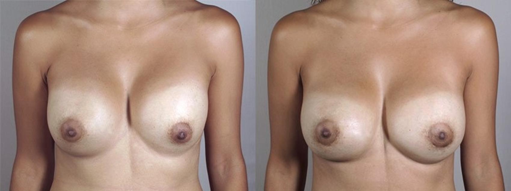 Breast Implant Revision Case 590 Before & After View #1 | Paramus, New Jersey | Parker Center for Plastic Surgery