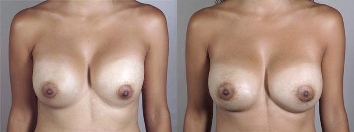 Breast Implant Revision Case 590 Before & After View #1 | Paramus, New Jersey | Parker Center for Plastic Surgery