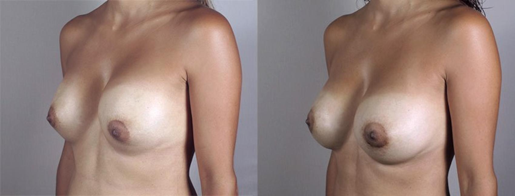 Breast Implant Revision Case 590 Before & After View #2 | Paramus, New Jersey | Parker Center for Plastic Surgery