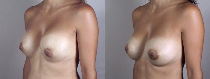 Breast Implant Revision Case 590 Before & After View #2 | Paramus, New Jersey | Parker Center for Plastic Surgery