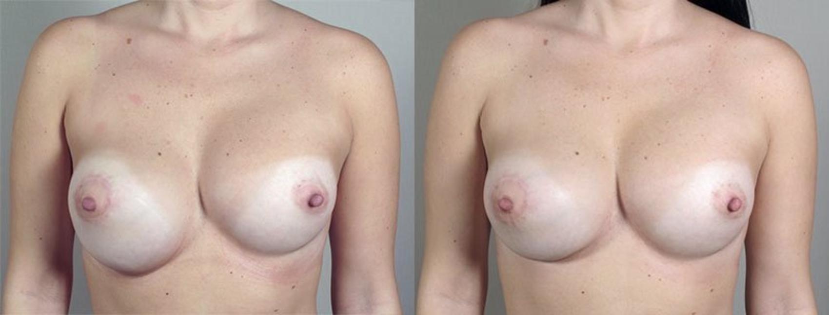 Breast Implant Revision Case 591 Before & After View #1 | Paramus, New Jersey | Parker Center for Plastic Surgery