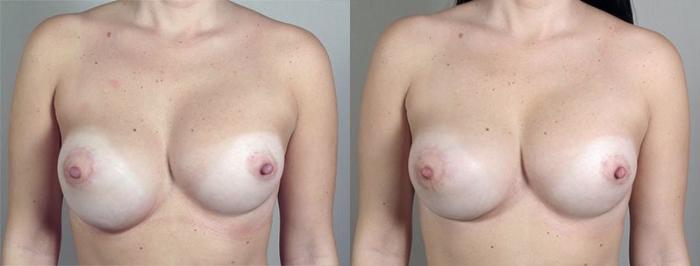 Breast Implant Revision Case 591 Before & After View #1 | Paramus, New Jersey | Parker Center for Plastic Surgery