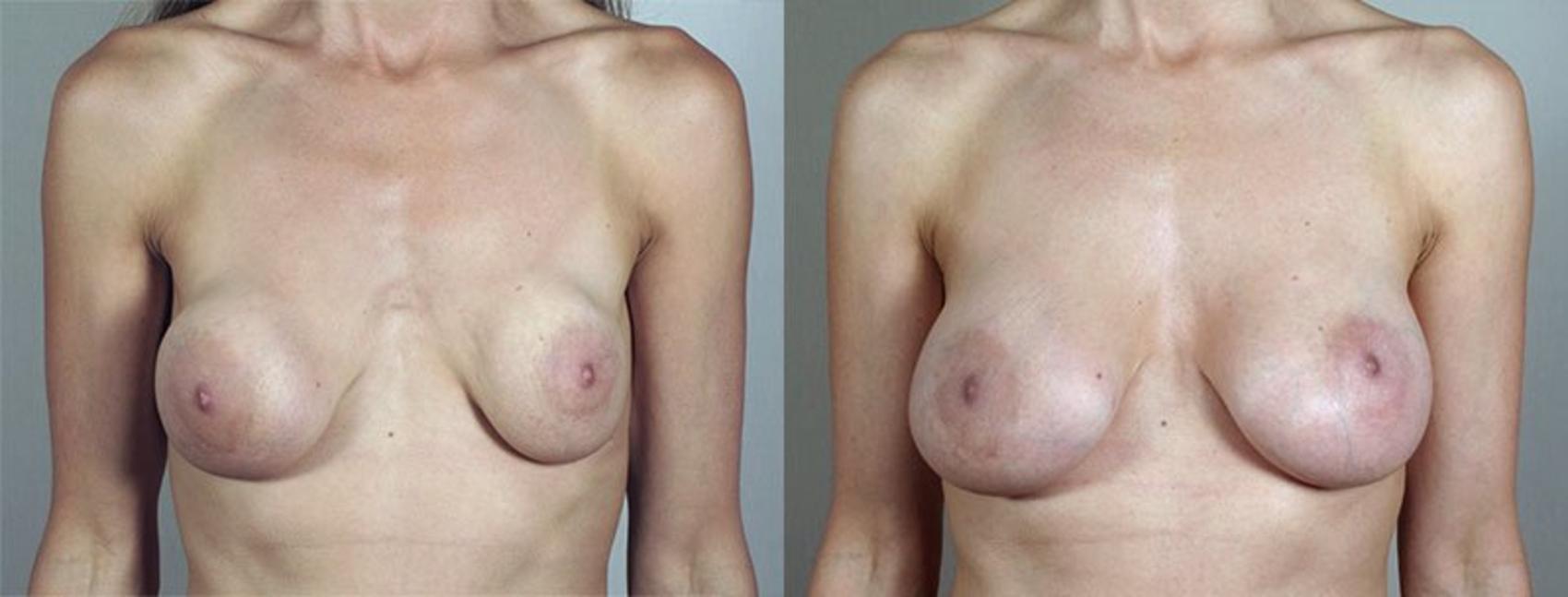 Breast Implant Revision Case 592 Before & After View #1 | Paramus, New Jersey | Parker Center for Plastic Surgery