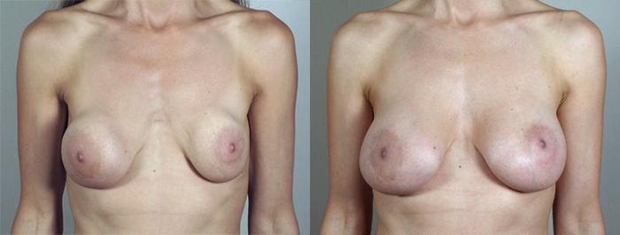 Breast Implant Revision Case 592 Before & After View #1 | Paramus, New Jersey | Parker Center for Plastic Surgery