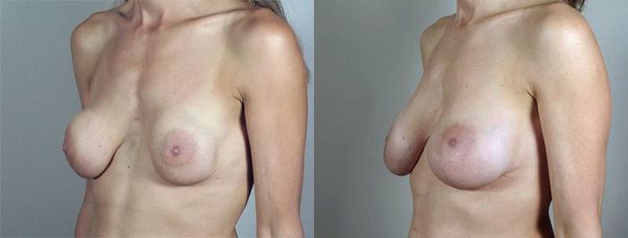 Breast Implant Revision Case 592 Before & After View #2 | Paramus, New Jersey | Parker Center for Plastic Surgery