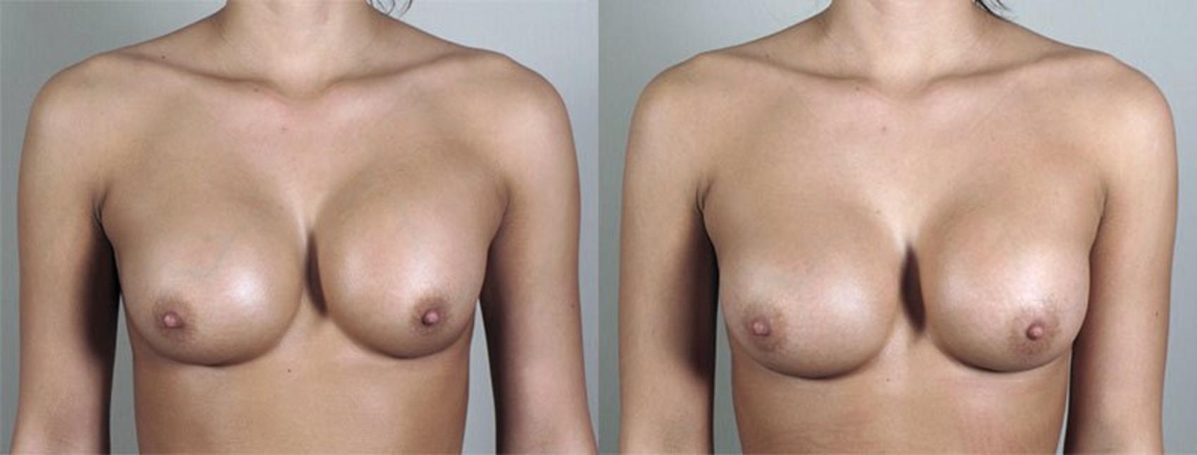 Breast Implant Revision Case 593 Before & After View #1 | Paramus, New Jersey | Parker Center for Plastic Surgery