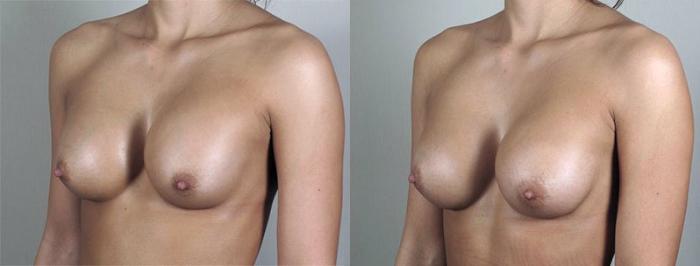 Breast Implant Revision Case 593 Before & After View #2 | Paramus, New Jersey | Parker Center for Plastic Surgery