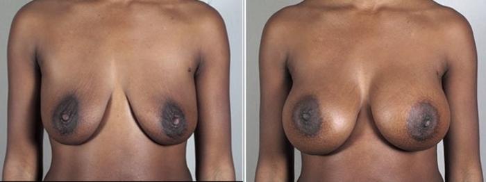 Breast Implant Revision Case 594 Before & After View #1 | Paramus, New Jersey | Parker Center for Plastic Surgery