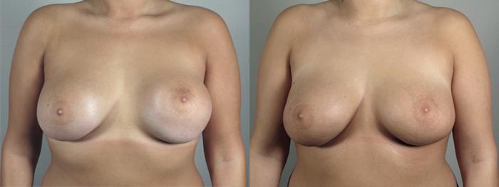 Breast Implant Revision Case 595 Before & After View #1 | Paramus, New Jersey | Parker Center for Plastic Surgery