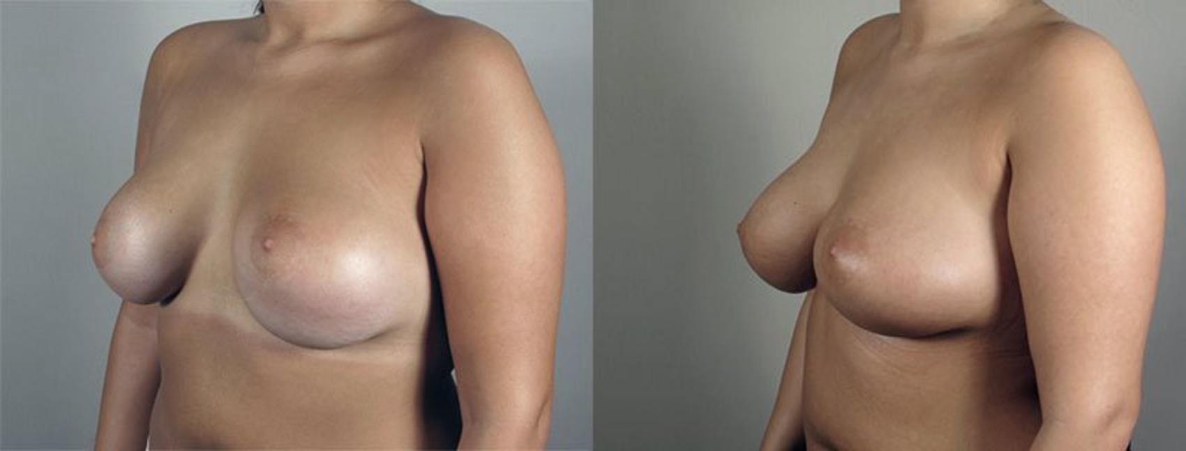 Breast Implant Revision Case 595 Before & After View #2 | Paramus, New Jersey | Parker Center for Plastic Surgery