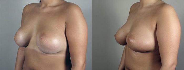 Breast Implant Revision Case 595 Before & After View #2 | Paramus, New Jersey | Parker Center for Plastic Surgery