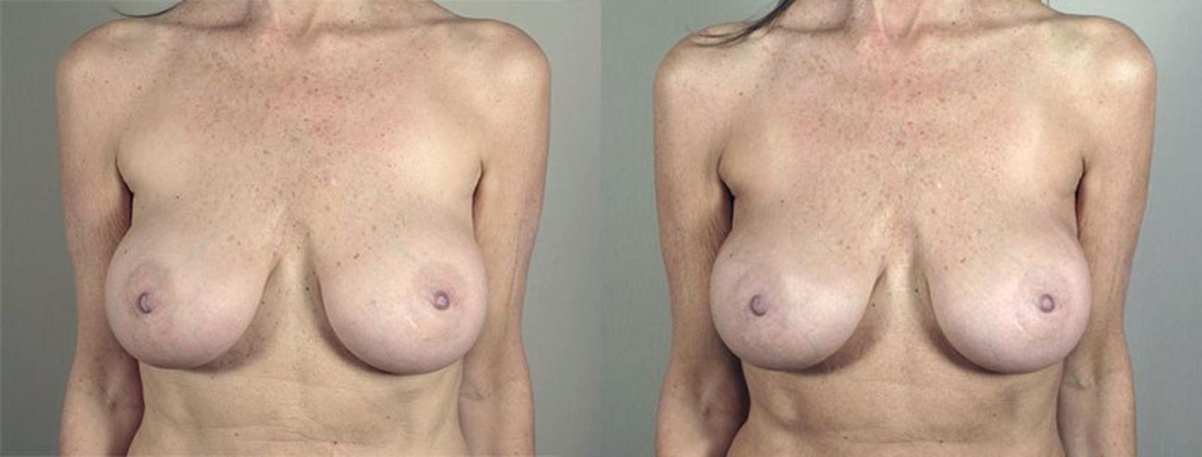Breast Implant Revision Case 596 Before & After View #1 | Paramus, New Jersey | Parker Center for Plastic Surgery