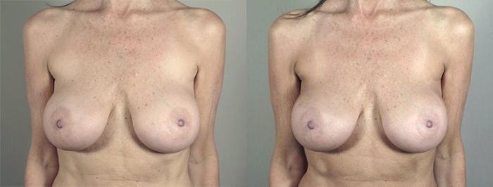 Breast Implant Revision Case 596 Before & After View #1 | Paramus, New Jersey | Parker Center for Plastic Surgery
