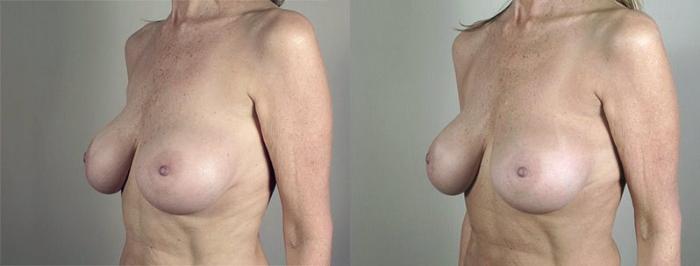 Breast Implant Revision Case 596 Before & After View #2 | Paramus, New Jersey | Parker Center for Plastic Surgery