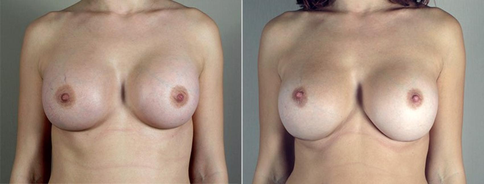 Breast Implant Revision Case 597 Before & After View #1 | Paramus, New Jersey | Parker Center for Plastic Surgery