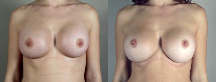 Breast Implant Revision Case 597 Before & After View #1 | Paramus, New Jersey | Parker Center for Plastic Surgery