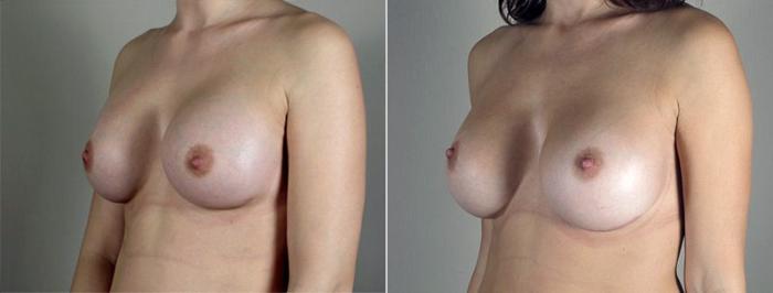 Breast Implant Revision Case 597 Before & After View #2 | Paramus, New Jersey | Parker Center for Plastic Surgery