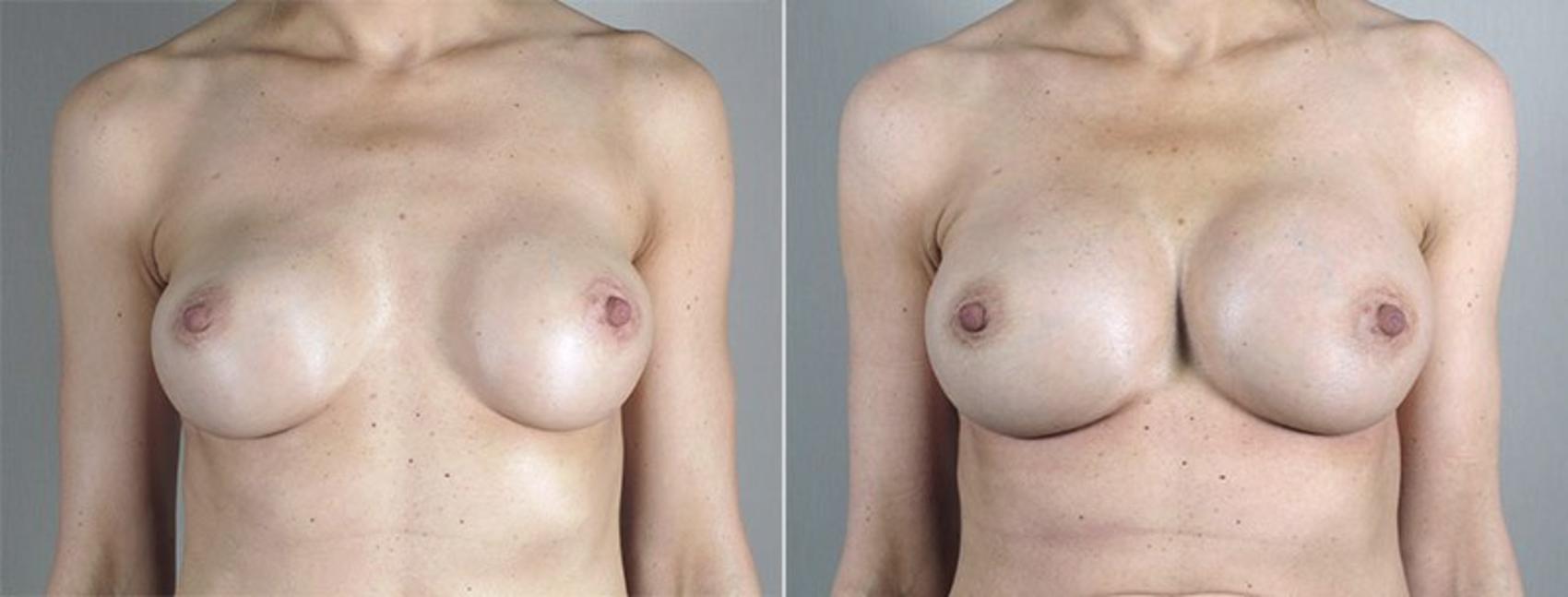 Breast Implant Revision Case 599 Before & After View #1 | Paramus, New Jersey | Parker Center for Plastic Surgery