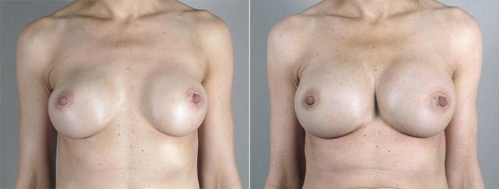 Breast Implant Revision Case 599 Before & After View #1 | Paramus, New Jersey | Parker Center for Plastic Surgery